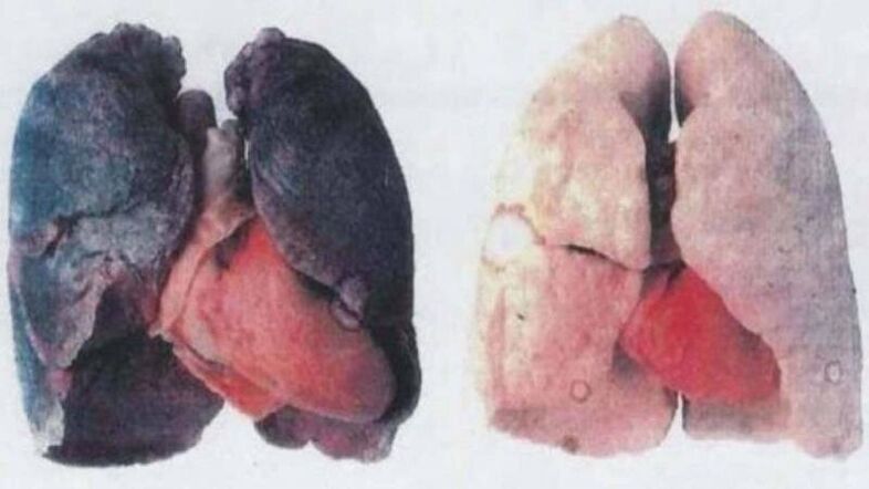 Birçok kronik alkolik akciğer hasarı nedeniyle ölüyor (solda)