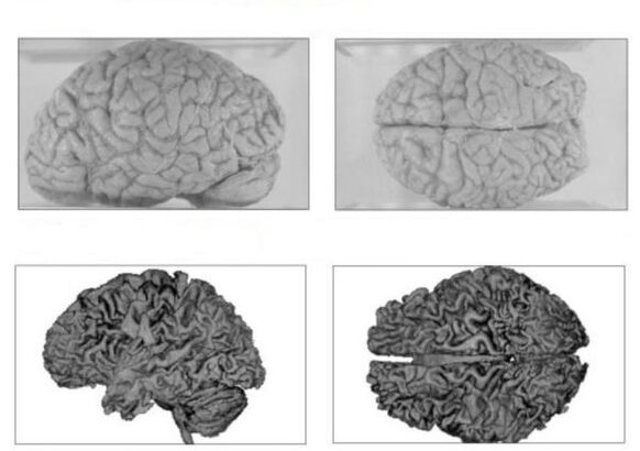 Sağlıklı bir insanın beyni (üstte) ve geri dönüşü olmayan sonuçları olan bir alkolik beyni (altta)